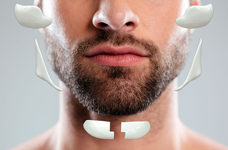 Implantes Faciais