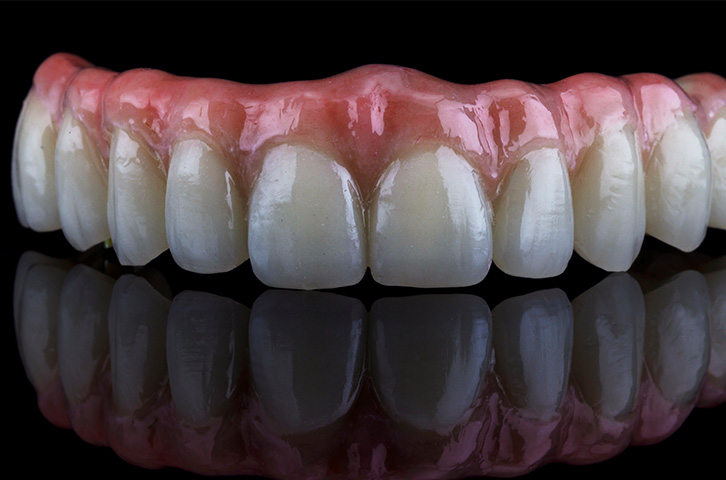 Implantes dentários